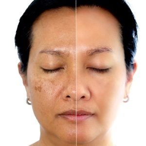 How Stress Affects Your Skin and Can Lead to Hyperpigmentation