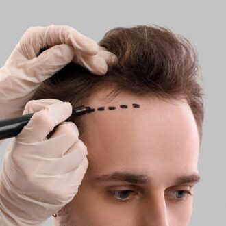 Hair Transplant for Crown Area in Islamabad