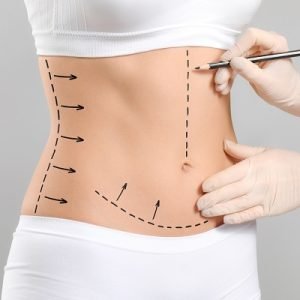 The Impact of Abdominoplasty on Body Image and Self-Esteem