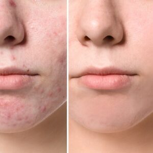 3 Non-Surgical Treatments for Acne Scars