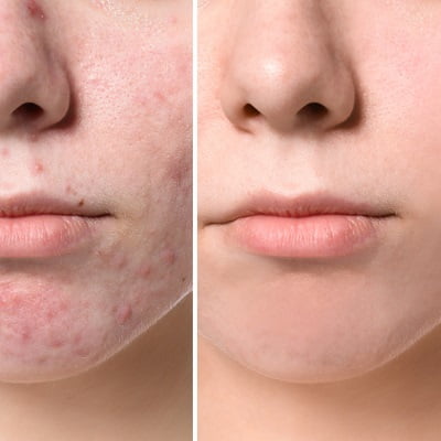 3 Non-Surgical Treatments for Acne Scars