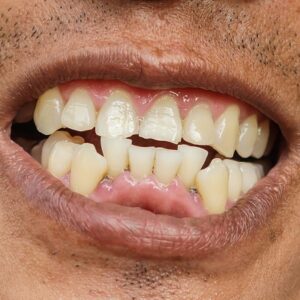 Can You Fix Protruding Teeth Naturally?