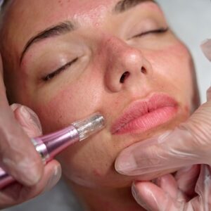 Face Look Bad After Microneedling?