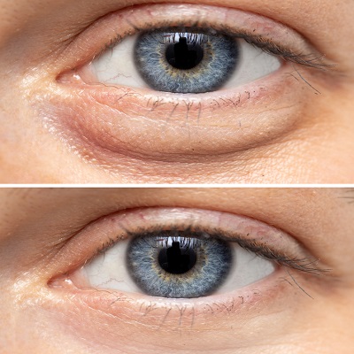 How Long the Eyelid Surgery Results Last