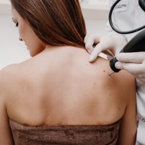 Mole Removal Cost in Islamabad
