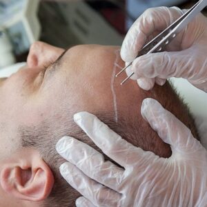 Key Considerations Before Opting for Hair Transplantation