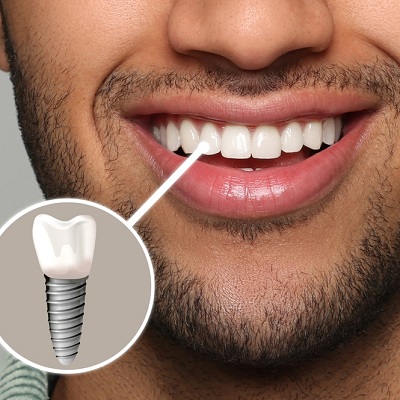 What Are the Risks & Benefits of Dental Implants