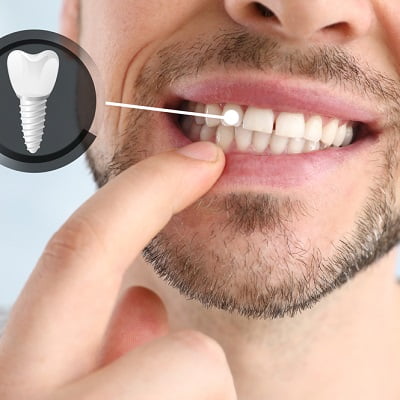 How Should I Look After My Dental Implant