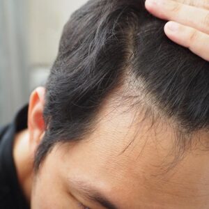 Reason Behind Crown Hair Not Growing