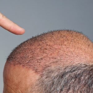 How Painful Are Hair Transplants?