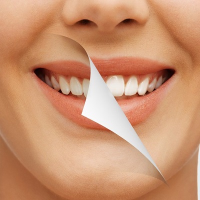 What is the Safest Method of Teeth Whitening in Islamabad?