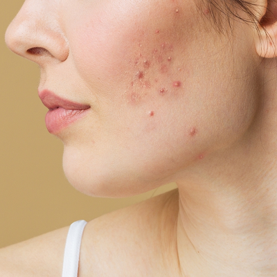 Best dermatology treatment for acne scars in Islamabad