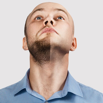 Can Beard Transplant Fail?