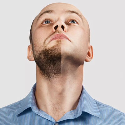 Can Beard Transplant Fail? | Beard Hair Transplant