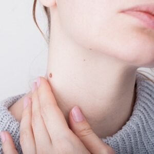 Remove Birthmark Non-Surgically