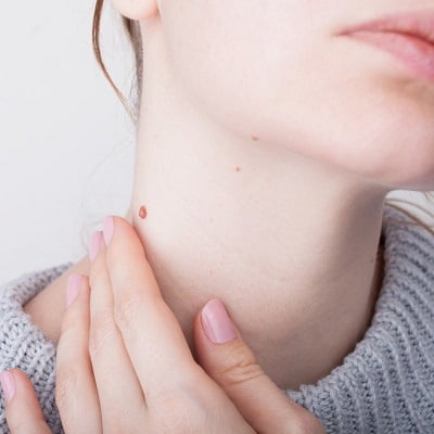 Is It Possible to Remove Birthmark Non-Surgically? | birthmark removal