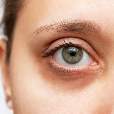 Does Anything Help Dark Circles? eye bags removal
