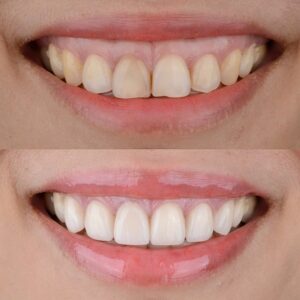 Reasons Fixing Your Gummy Smile