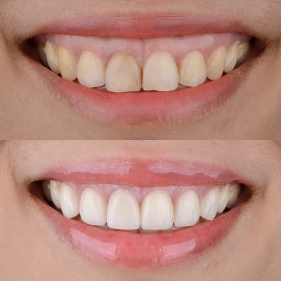 3 Reasons Fixing Your Gummy Smile Is Worth It?