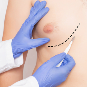 Do Nipples Shrink After Gynecomastia Surgery?