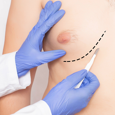 Do Nipples Shrink After Gynecomastia Surgery?
