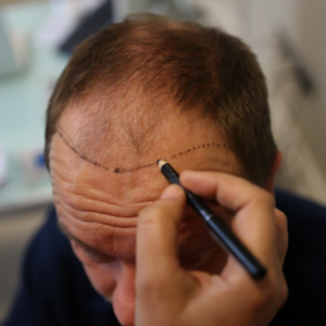 Why My Hair Transplant Doesn’t Look Natural?