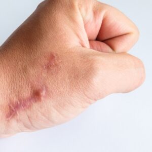 CO2 Laser for Hypertrophic Scars in Islamabad