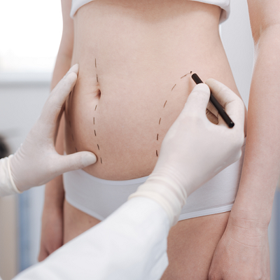 Is Liposuction Really Better Than Dieting?
