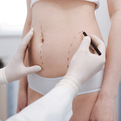 Is Liposuction Really Better Than Dieting? | weight loss