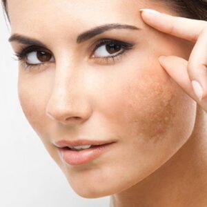 Why is my melasma getting darker?