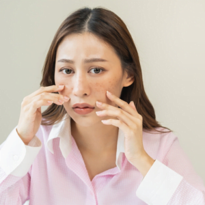 Which Type of Melasma Is Most Difficult to Treat?