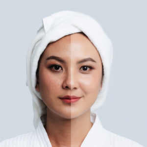 Is CO2 Laser Helps in Removing Hyperpigmentation?