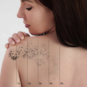 Can I Use Cream Instead of Laser Tattoo Removal?