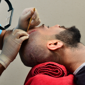 Can We Have A Hair Transplant Without Shaving?