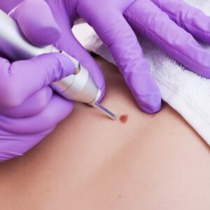 Wart Removal Specialist in Islamabad