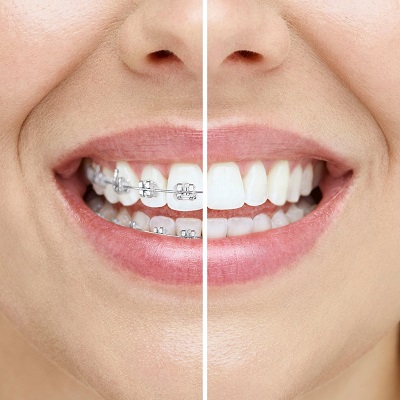 Do they whiten teeth after dental braces?