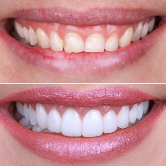 How Much Does E-Max Veneers Cost in Islamabad?