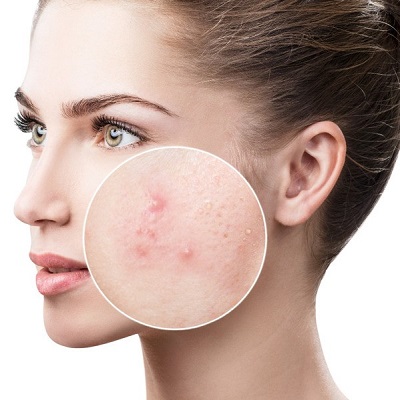 How to prevent acne scars & pimple marks?