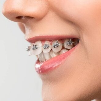 Is Protruding Teeth Genetics?