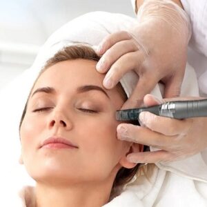 Microneedling for stretch marks: An effective solution