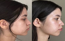 Red Carpet Facial cost in Islamabad