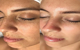 Red Carpet Facial
