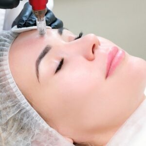 Effective treatment than microneedling