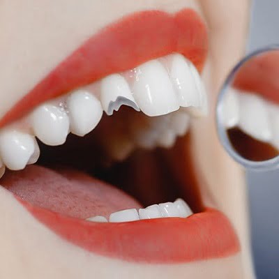 Can A Cracked Tooth Be Filled?