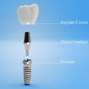 Can Dental Implants Be Placed During Pregnancy?