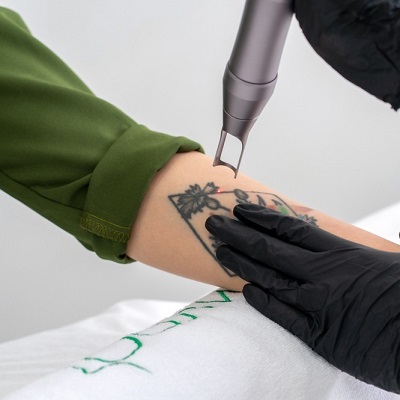 Laser Tattoo Removal Cost in Islamabad