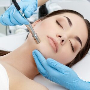 Microdermabrasion For Melasma Treatment