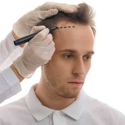 Procedure Followed for Hair Transplant in Islamabad