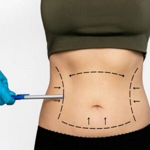 Will My Waist Be Smaller After Liposuction?