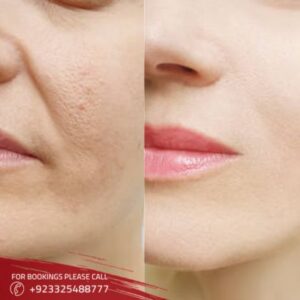 Botox Fillers Treatment in Islamabad